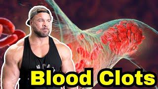 DVT and Blood Clots. My Experience