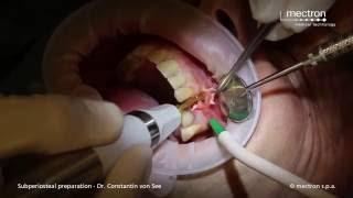 PIEZOSURGERY - Dr. Constantin von See - Ultrasonic periosteal dissection