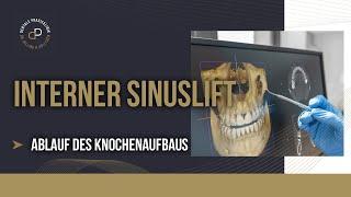 Interner Sinuslift – Knochenaufbau für Zahnimplantate