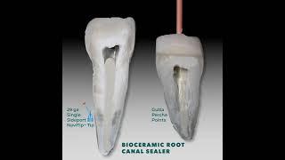 Delivering MTApex™ bioceramic root canal sealer