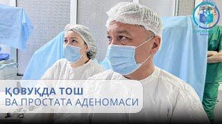 Қовуқда тош ва простата аденомаси