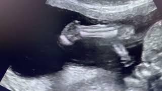 Ultrasound Club foot ultrasound #sonography #radiology #ultrsoundreading #medical #medicalstudent