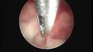 Hystroscopic polypectomy by Dr/ waleed almery