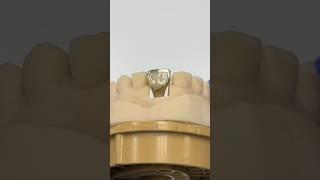 Angle Screw Channel Implant with a Gold Facing @EnvisiontecMain #envisiontec #lsk121shorts