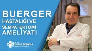 Buerger Hastalığı ve Sempatektomi Ameliyatı | Kalp ve Damar Cerrahisi - Prof. Dr. Yavuz Beşoğul