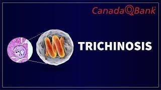 Trichinosis