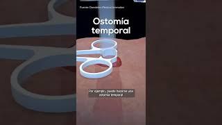 ¿Qué es una OSTOMÍA? 🩺🩹
