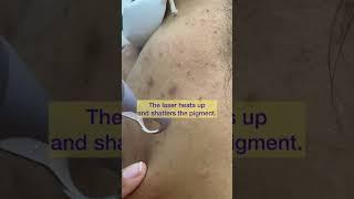 Laser Skin toning for dark spots - Nypunya Aesthetic Clinic- Bangalore