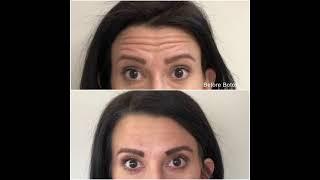 Botox results at The Skin Center Pittsburgh Columbus
