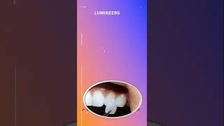 Laminates# veneers#Luminates# Prosthohub#shorts
