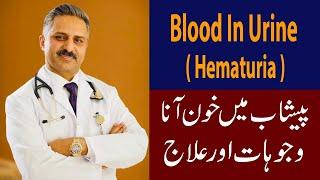 Blood in Urine ( Hematuria) , Causes & Treatment.