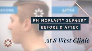 Rhinoplasty Transformations - Before & After Pictures | Dr. Buonassisi, 8 West Clinic in Vancouver