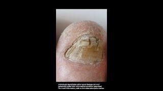 Signs Of Fungal Nail Infection - Nail Fungus What To Look For #fungalnails #fungalinfection