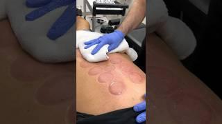 Part 5: Back pain since fifteen years old!  **AWESOME CRACKS** and Sports Massage Therapy!