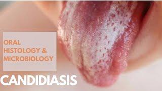 Classification of Oral Candidiasis | Oral Manifestation of Tuberculosis