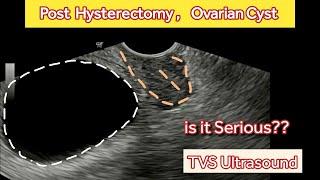 Post Hysterectomy  Ovarian Cyst | TVS Ultrasound