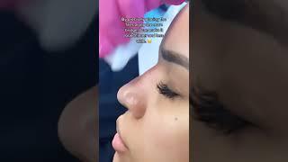 LIQUID RHINOPLASTY: BEAUTIFUL RESULTS!