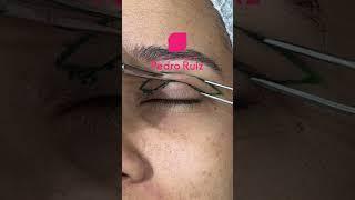 Blefaroplastia - A cirurgia das pálpebras  #shorts