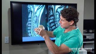 What is Cervical Stenosis? Causes, Symptoms, and Surgical Options for Neck Pain Relief