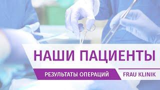 3D Моделирование подтяжка кожи лица без операции Frau Klinik