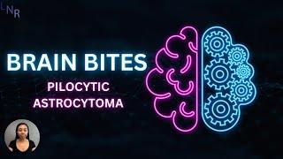 Brain Bites – Pilocytic astrocytoma