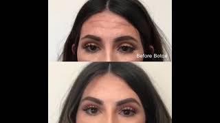 Preventative Botox at The Skin Center