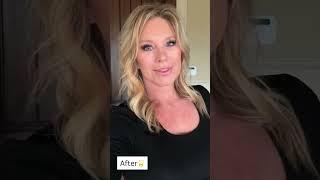 Dr. Amir Karam COMPLETELY TRANSFORMS Patient's Appearance with Vertical Restore Facelift!