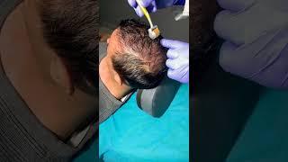 Derma Roller After PRP For Hair Loss Treatment | PRP Therapy |  Skinaa Clinic #shorts #viral #short