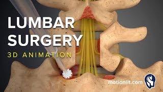 Lumbar Surgery - Laminectomy - 3D Medical Animation