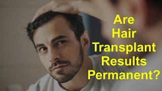 Are Hair Transplant Results Permanent?