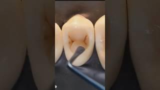 Dental motivation. Direct composite restoration teeth. #dental #dentistry #dentaltreatment