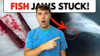 Kite Surfing Injury Turns Crazy: Needlefish Jaw Found in Foot 6 Months Later!