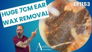 One Of Our Biggest Ear Wax Removals! - EP1153