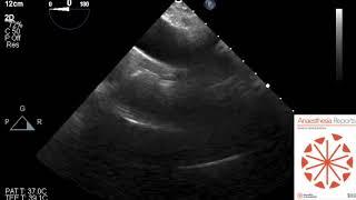TOE echocardiography guided retrieval of shattered aortic cross-clamp from the mediastinum
