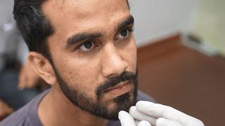 Man Punched on The Nose Gets Rhinoplasty - Pre Surgery