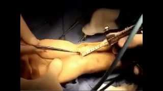 Arthroscopic Reduction / Volar Plating of Distal Radius Fracture - Dr. Badia, Best Hand Surgeon