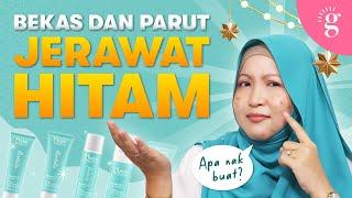 Cara Hilangkan Bekas Dan Parut Jerawat Hitam Dengan Berkesan | Review Nurish Organiq