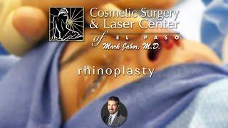 Rhinoplasty - Dr. Mark Jabor I Cosmetic Surgery & Laser Center of El Paso