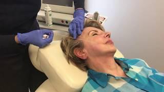 PDO Threadlift for midface lift with Dr. Shalini Gupta