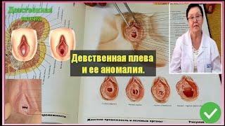 Девственная плева и ее аномалия (hymen).