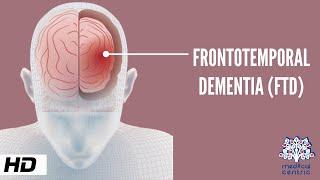 Frontotemporal Dementia, Causes, Signs and Symptoms, Diagnosis and Treatment.