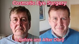 Cosmetic Eye Surgery - Before and After Diary - Blepharoplasty, Direct Brow Lift and Mid Face Lift