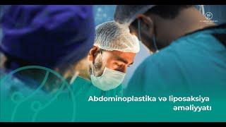 Dr. Rəşad Babayev - Abdominoplastika və liposaksiya əməliyyatı