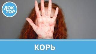 Корь у взрослых и детей. Как передается, симптомы, опасные последствия, вакцинация