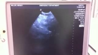 Zonare ultrasound session 1 NSH ED