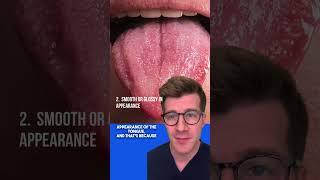 Signs of IRON DEFICIENCY ANAEMIA in the TONGUE | Glossitis explained #shorts  #health #anaemia