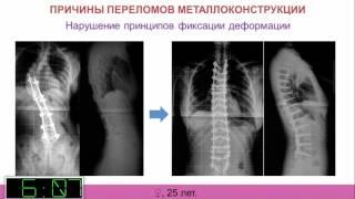 Осложнения в хирургии позвоночника