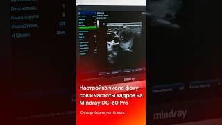 Число фокусов и частота кадров на УЗИ на примере Mindray DC-60 Pro | @medliga #short #shorts