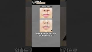 성숙도는 인중과 비례? 흉터 없는 인중축소에 대해 알려줌!ㅣ리스펙성형외과