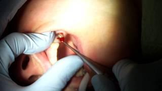 simple root tip extraction,dental.part 1